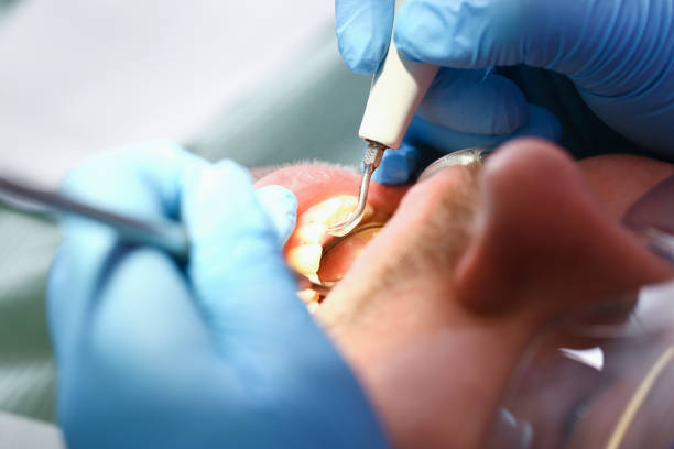 Best Dentist for Tooth Abscess  in Williamsport, IN